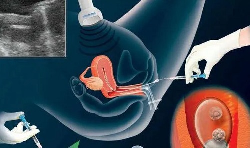 精子死了对做泰国试管婴儿的影响大不大？